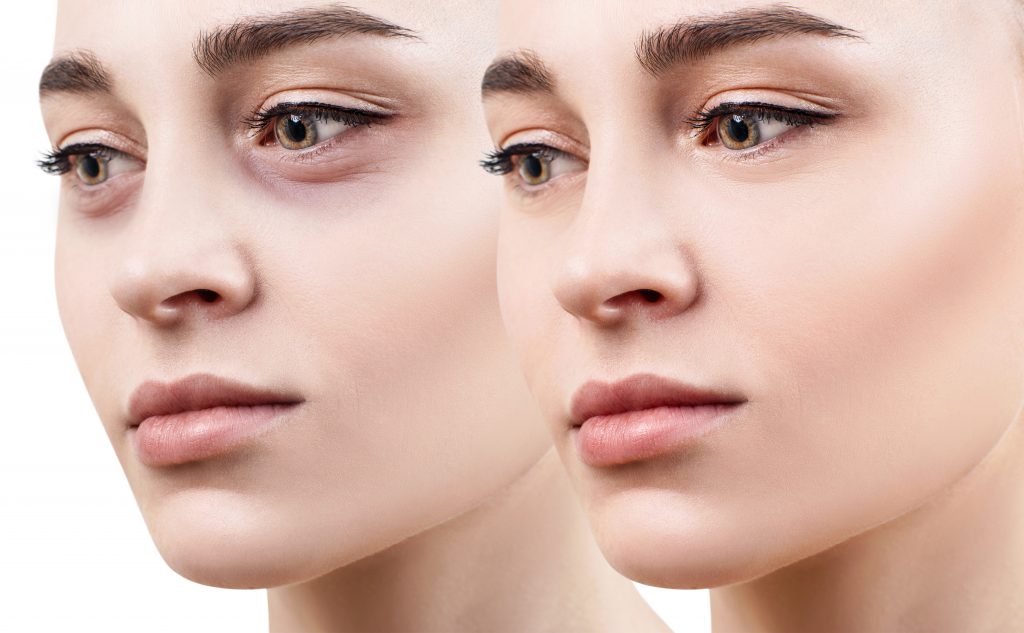 Tear trough deformity, under eye lines