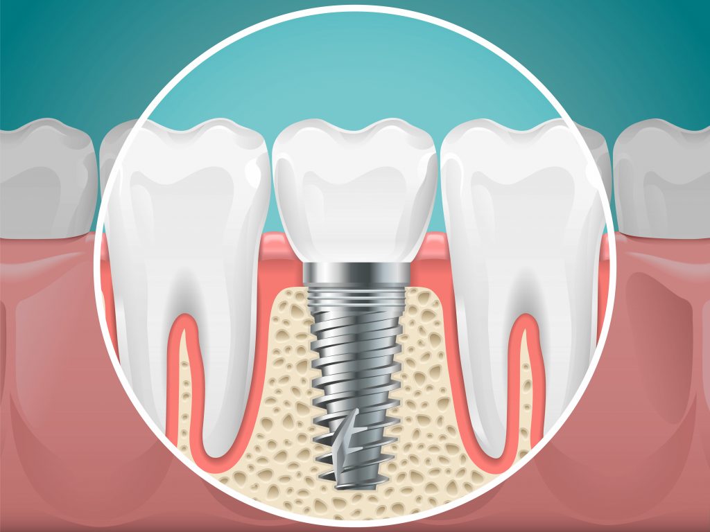 Dental implants