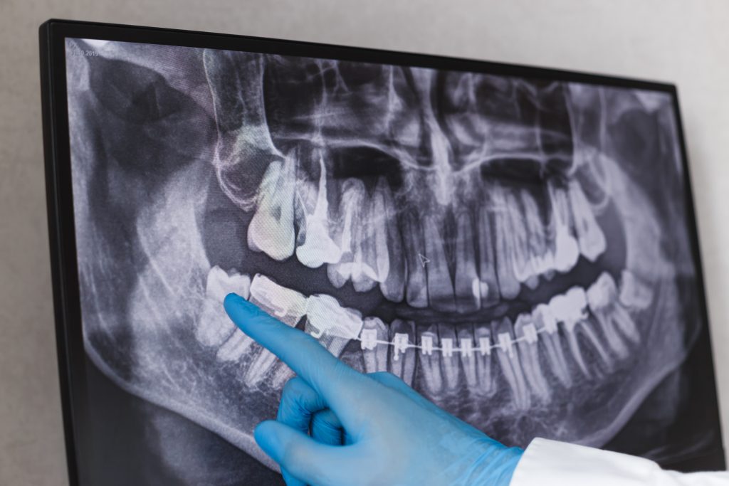 Surgical teeth removal