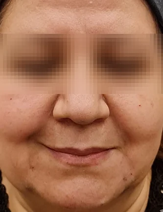 A after dermal fillers at allura medical