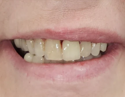 A patient smiling after dental implants at allura medical