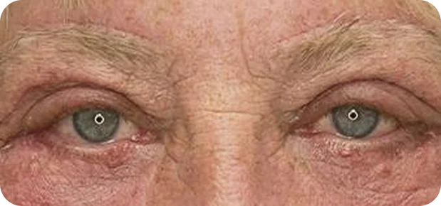 After: Before and after treatment