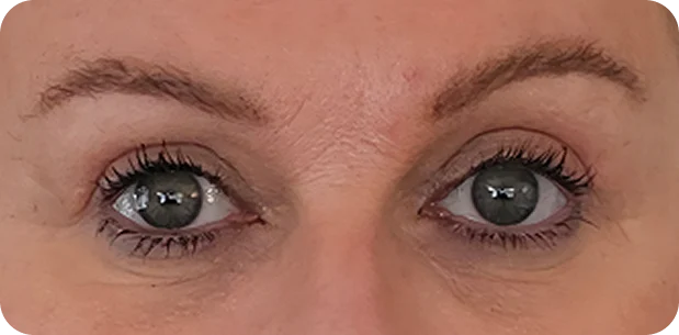 After: Before and after treatment
