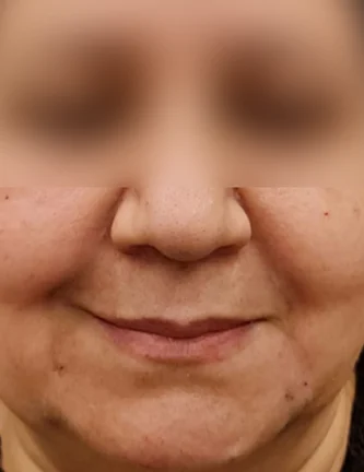 After: Before and after treatment