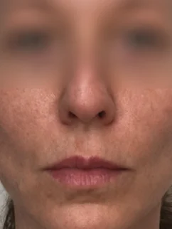 After: Before and after treatment