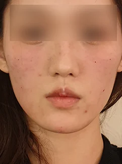 After: Before and after treatment