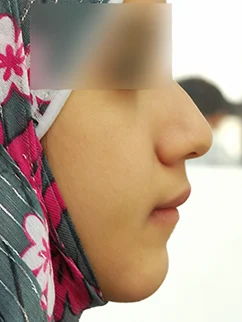 After: Before and after treatment