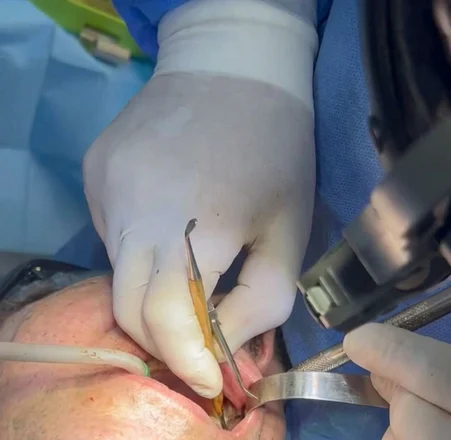 Dental Implant Surgery